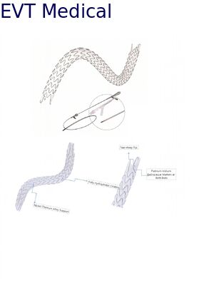 Large Lumen Urethral Stent Hydrophobic Nitinol Design For Precision Placement