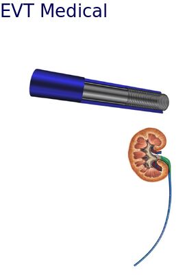 Smart Urethral Access Sheath Bluetooth Alerts 35cm Length With Pressure Monitoring