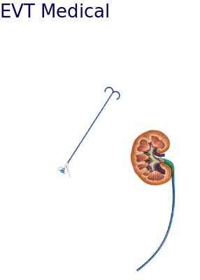 Dual Lumen Ureteral Access Sheath Endoscopic Procedures Access Sheath Urology