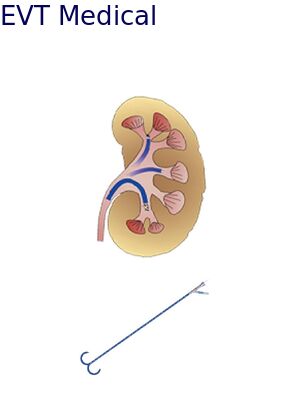 High Value Ureteral Access Sheath Endourology Practices Access Sheath Urology