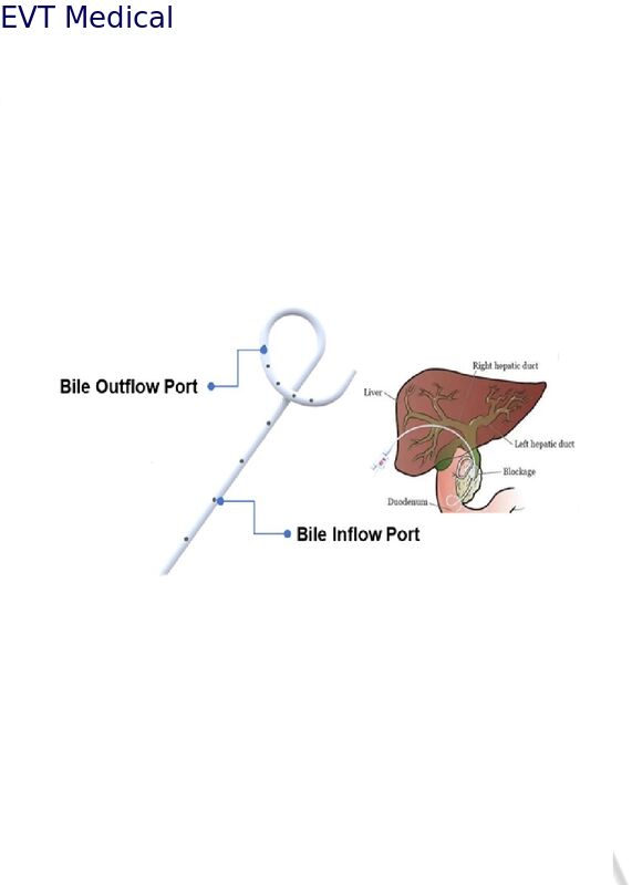 Long Pigtail Loop Biliary Drainage Tube for Internal‑External Bile Drainage Medical Grade PU High Flow Design