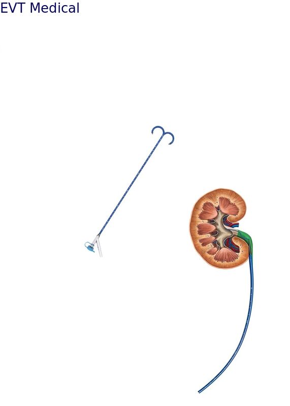 Dual Lumen Ureteral Access Sheath Endoscopic Procedures Access Sheath Urology