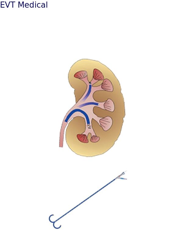 High Value Ureteral Access Sheath Endourology Practices Access Sheath Urology